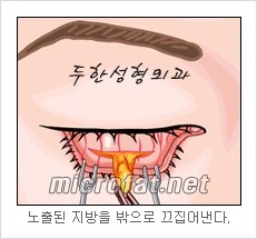 두한성형외과 눈밑성형 - 눈밑지방제거, 눈밑주름, 눈밑지방재배치 관련 이미지 6