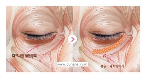 [두한성형외과 FOCUS 눈밑성형] - [다크써클의 치료방법 -  콜펫(Col-fat) 눈밑 미세지방이식 ③] 관련 이미지 2