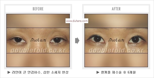 [두한성형외과 경쟁력 눈성형] - [나에게 맞는 어울리는 쌍꺼풀 라인] 관련 이미지 18