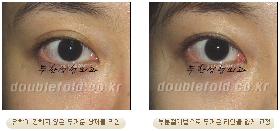 [두한성형외과 눈재수술] - [부분절개법 재수술] 관련 이미지 39