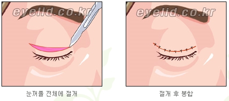 [두한성형외과 눈성형] - [쌍커풀수술] 관련 이미지 4