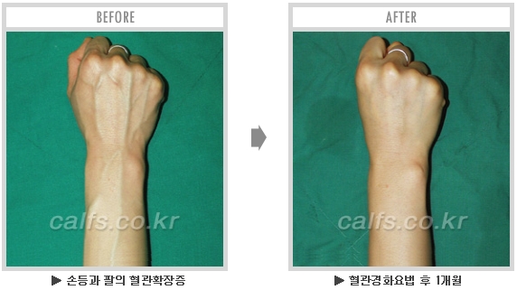 [종아리성형 두한성형외과] - [종아리수술에 대한 자주하는 질문과 답변 모음] 관련 이미지 46