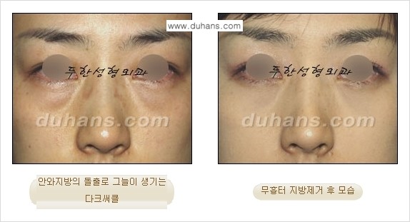 [두한성형외과 젊은 눈매 안검성형] - [눈밑 지방제거의 수술 전후 안내 ②] 관련 이미지 8