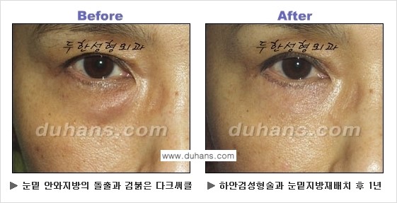 [두한성형외과의 상큼하고 환한 젊은 눈매완성] - [하안검 성형술 ②] 관련 이미지 6