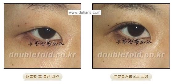 [두한성형외과 경쟁력 쌍꺼풀 재수술, 극한 눈재수술] - [풀린 쌍꺼풀 라인 교정수술 안내] 관련 이미지 7
