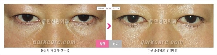 [두한성형외과 경쟁력 눈밑성형] - [눈밑 지방재배치의 문제점 안내] 관련 이미지 4