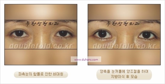 [두한성형외과 경쟁력 눈성형] - [비대칭 쌍꺼풀 라인의 여러 가지 교정 방법] 관련 이미지 20