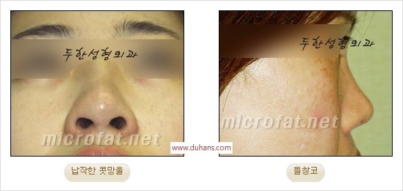 [두한성형외과 경쟁력 코성형 리더] - [자연스럽고 오똑한 콧망울! 코성형 방법]​ 관련 이미지 39