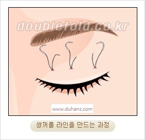 [두한성형외과 경쟁력 눈성형] - [자연스럽고 아름다운 눈매를 만드는 여러 가지 눈성형 방법] 관련 이미지 11