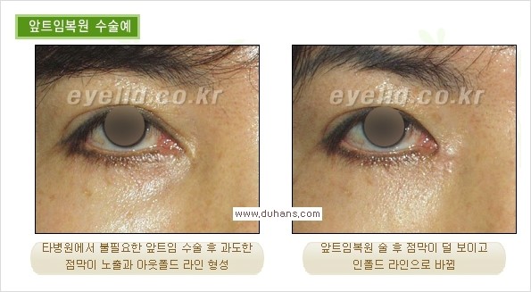 [두한성형외과 경쟁력 쌍꺼풀 재수술, 극한 눈재수술)] - [과도한 앞트임이 되었을 경우 교정 방법 안내] 관련 이미지 2