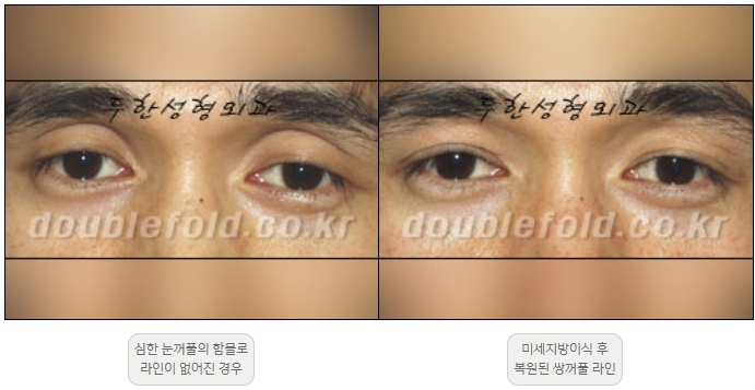 [두한성형외과 쌍커풀재수술] - [풀린 쌍커풀라인 교정] 관련 이미지 16