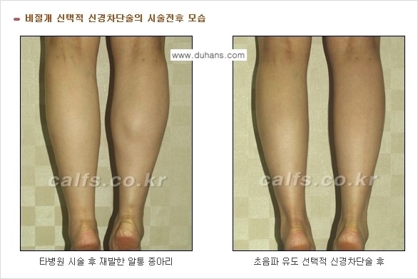 ​[두한성형외과와 날씬한 종아리 만들기!] - [간편하고 안전한 종아리 축소방법 ③] 관련 이미지 7