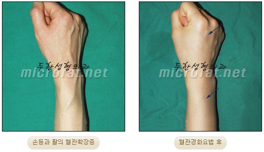 [Duhan Plastic Surgery Clinic Varicose Veins] - [Hand and Arm Venous Dilation] image 11