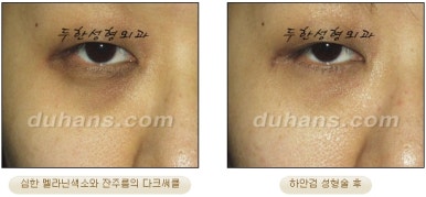 Blepharoplasty, Duhan Plastic Surgery - Upper and Lower Eyelids image 40