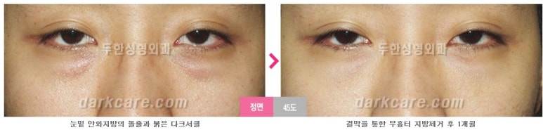 [두한성형외과 다크서클] - [다크서클 전후사진 검증] 관련 이미지 100