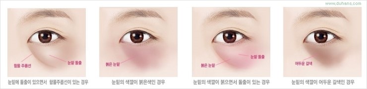 [두한성형외과 경쟁력 눈밑성형] - [다크써클의 원인과 종류, 다크써클의 치료 방법] 관련 이미지 41