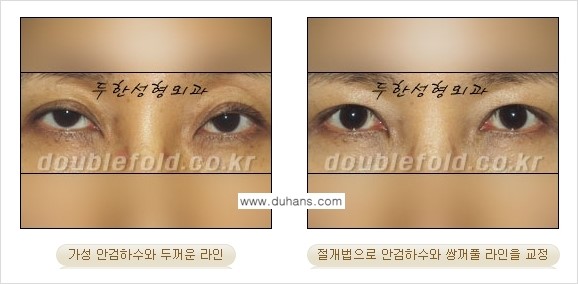 [두한성형외과 NO.1 "극한 눈(쌍꺼풀 재수술)"] - [안검하수(졸린눈매) 재수술 안내 3.] 관련 이미지 10