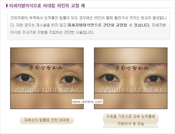 [두한성형외과 NO.1 눈성형] - [함몰된(꺼진) 눈꺼풀에서 쌍꺼풀 라인 교정 3.] 관련 이미지 1