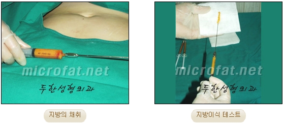 Fat Grafting Leader Duhan Plastic Surgery - Everything About Fat Grafting image 6