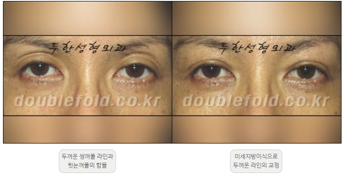 [Duhan Plastic Surgery Double Eyelid Revision] - [Thick Double Eyelid Line] image 20