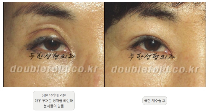 [Double Eyelid Surgery, Duhan Plastic Surgery] - [Extreme Revision Eye Surgery to Correct a Damaged Line] image 5