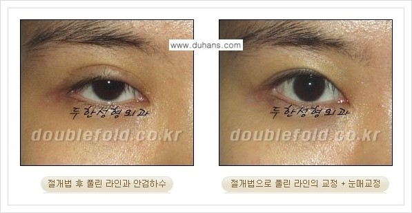 [두한성형외과 경쟁력 쌍꺼풀 재수술, 극한 재수술] - [쌍꺼풀 라인이 풀렸을 경우 쌍꺼풀 재수술 안내] 관련 이미지 4