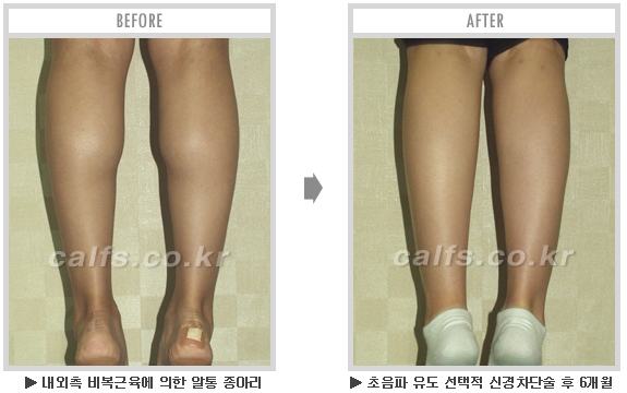 [종아리성형 두한성형외과] - [종아리수술에 대한 자주하는 질문과 답변 모음] 관련 이미지 65