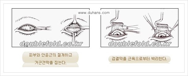 [두한성형외과 경﻿쟁력 눈성형] - [안검하수(졸린눈매) 종류와 교정 수술 안내] 관련 이미지 11