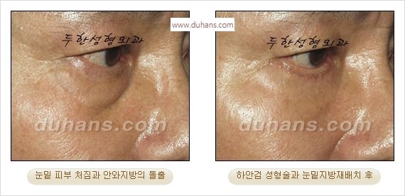 [두한성형외과 경쟁력 안검성형] - [눈밑주름 제거수술] 관련 이미지 26