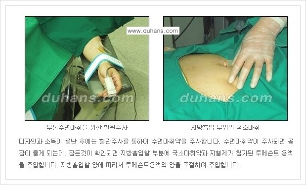 [두한성형외과 경쟁력 지방흡입] - [초음파 간편지방흡입 안내 ②] 관련 이미지 3
