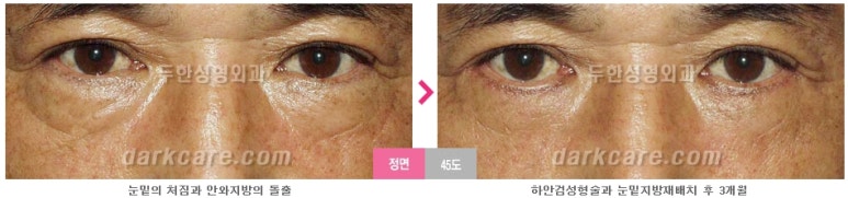 [두한성형외과 다크서클] - [다크서클 전후사진 검증] 관련 이미지 113