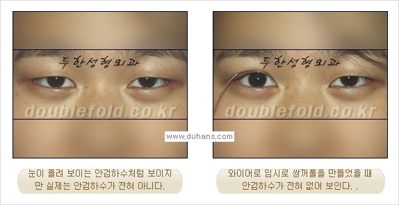 [두한성형외과 경쟁력 눈성형] - [안검하수(졸린눈매) 눈매교정 여러 가지 방법 안내] 관련 이미지 4