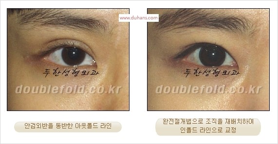 [두한성형외과 경쟁력 눈성형] - [완전절개법(Full incision method)의 재수술 과정] 관련 이미지 14