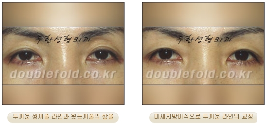 [Eye Reoperation Duhan Plastic Surgery] - [Guide to Double Eyelid Revision Surgery] image 47