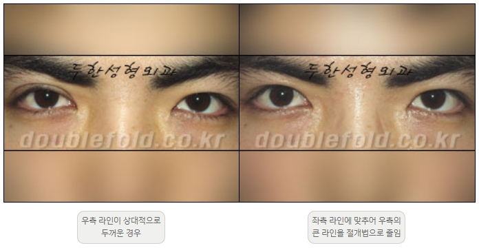 [두한성형외과 쌍커플재수술] - [비대칭 쌍커풀 라인] 관련 이미지 8