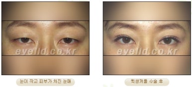 [Double Eyelid Surgery Duhan Plastic Surgery] - [Buried Method, Incision Method, Partial Incision Method] image 27