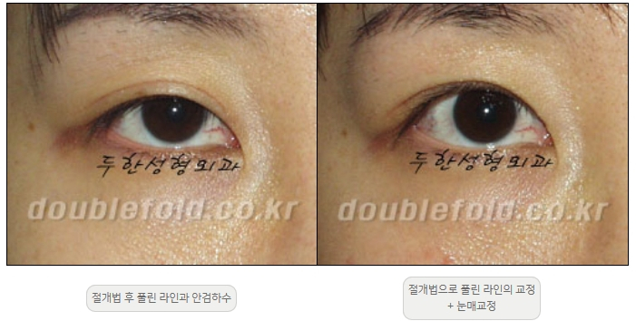 [두한성형외과 쌍커풀재수술] - [풀린 쌍커풀라인 교정] 관련 이미지 7