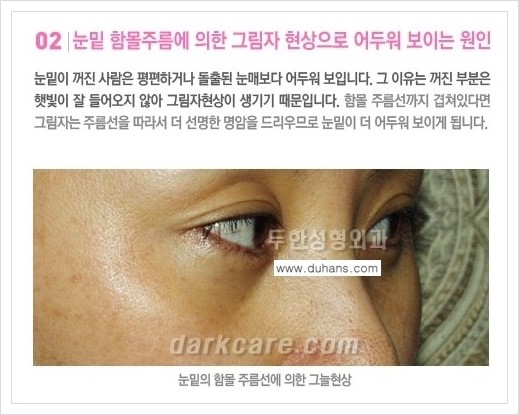 [두한성형외과 경쟁력 다크써클 교정] - [다크써클의 원인 안내] 관련 이미지 4