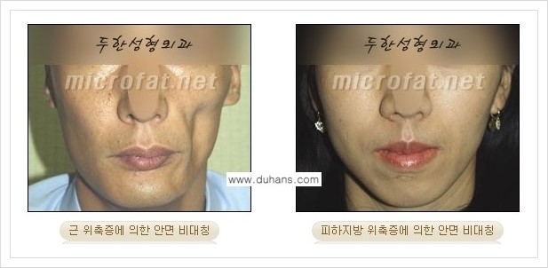 ⁠⁠[두한성형외과 경쟁력 볼살지방이식] - [심하게 야윈 주름이 있는 얼굴, 역삼각형 협소한 얼굴, 광대뼈가 돌출되어 보이는 경우 안내] 관련 이미지 4
