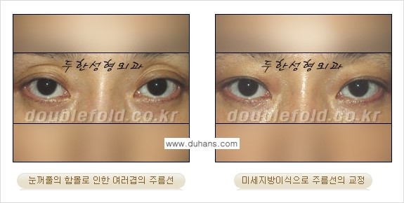 [두한성형외과 경쟁력 눈성형] - [삼중(세겹) 쌍꺼풀 라인의 교정] 관련 이미지 21