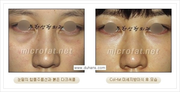 [두한성형외과 경쟁력 눈밑성형] - [눈밑 다크써클과 눈밑 함몰주름의 최적화 교정방법 안내] 관련 이미지 13