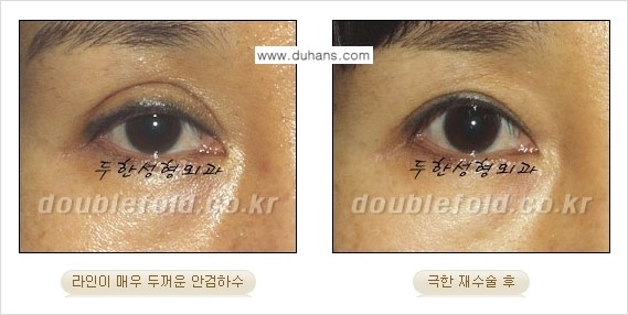 [두한성형외과 경쟁력 쌍꺼풀 재수술, 극한 눈재수술] - [망친 쌍꺼풀을 복원하는 극한 눈재수술] 관련 이미지 4