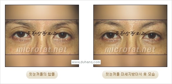 [두한성형외과 경쟁력 미세지방이식] - [꺼진(함몰된) 윗눈꺼풀 미세지방이식] 관련 이미지 9