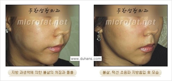 ​[두한성형외과 가을엔 지방흡입을] - [볼살, 눈밑, 턱선 초음파 미세지방흡입] 관련 이미지 11