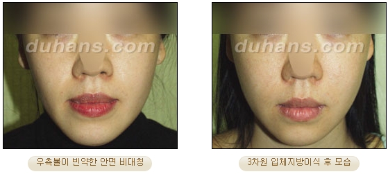 [두한성형외과 얼굴자가지방이식] - [볼살, 이마, 측두부] 관련 이미지 28