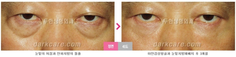 [두한성형외과 다크서클] - [다크서클 전후사진 검증] 관련 이미지 128
