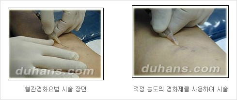 [두한성형외과 경쟁력 정맥류 치료] - [정맥류와 정맥확장증 치료] 관련 이미지 9