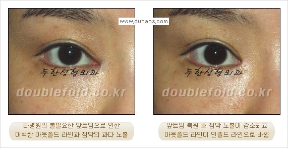 ​[두한성형외과 경쟁력 쌍꺼풀 재수술, 극한 눈재수술] - [쌍꺼풀 재수술시 지나친 아웃폴드 라인, 과도한 앞트임, 피부가 모자라 토안증 발생했을 경우 문제] 관련 이미지 2