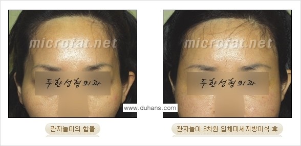 [두한성형외과 경쟁력 미세지방이식] - [두한성형외과 Col-fat(콜펫) 지방이식으로 교정이 가능한 부위 안내] 관련 이미지 3