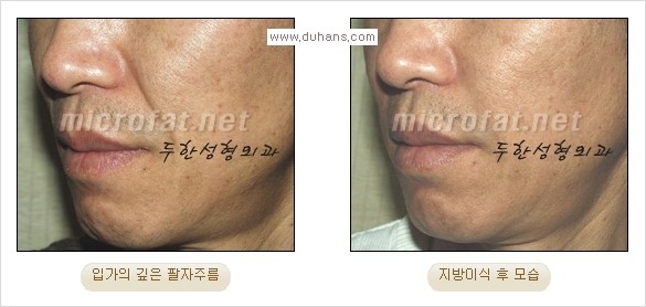 [두한성형외과 경쟁력 주름성형] - [코 옆과 입가에 걸쳐서 형성된 주름을 교정해주는 미세지방이식] 관련 이미지 16